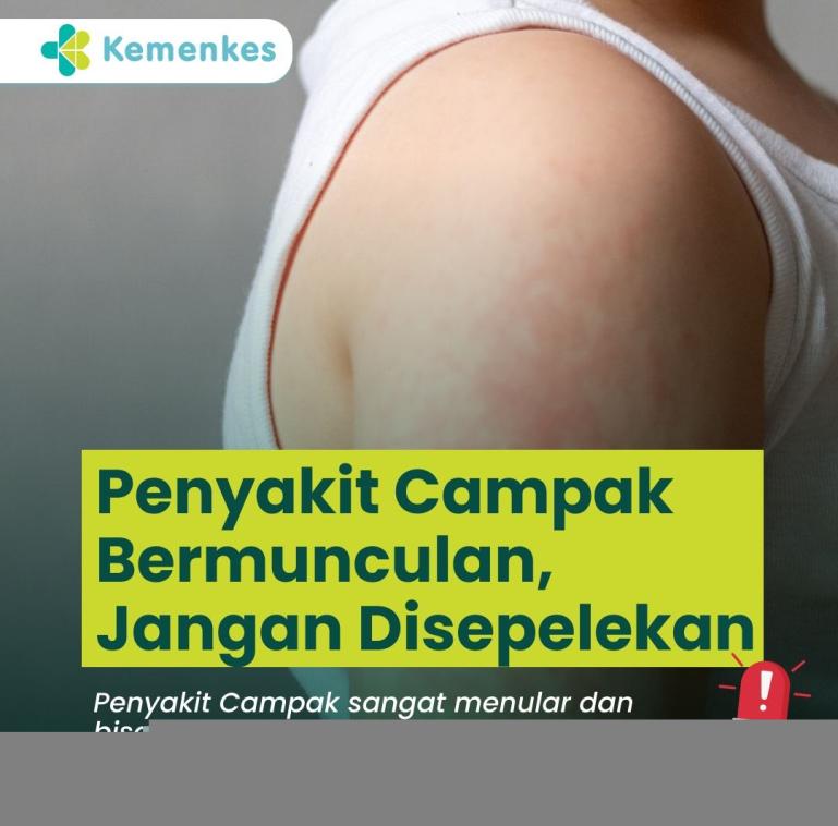 Imbauan Kemenkes menyangkut kemunculan penyakit Campak yang kini sedang berkembang di Indonesia. IST